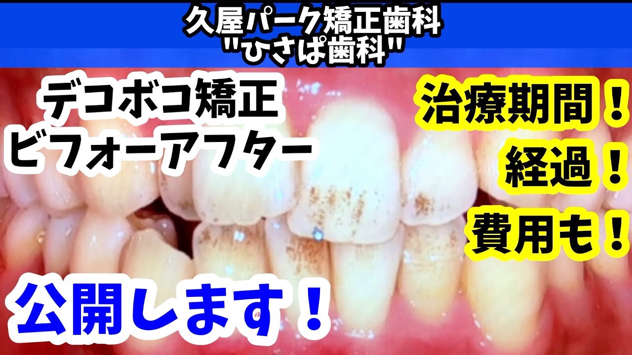 【矯正年間800例】実際の矯正症例ビフォーアフター①　治るまでの過程、詳細公開します！【名古屋のど真ん中】