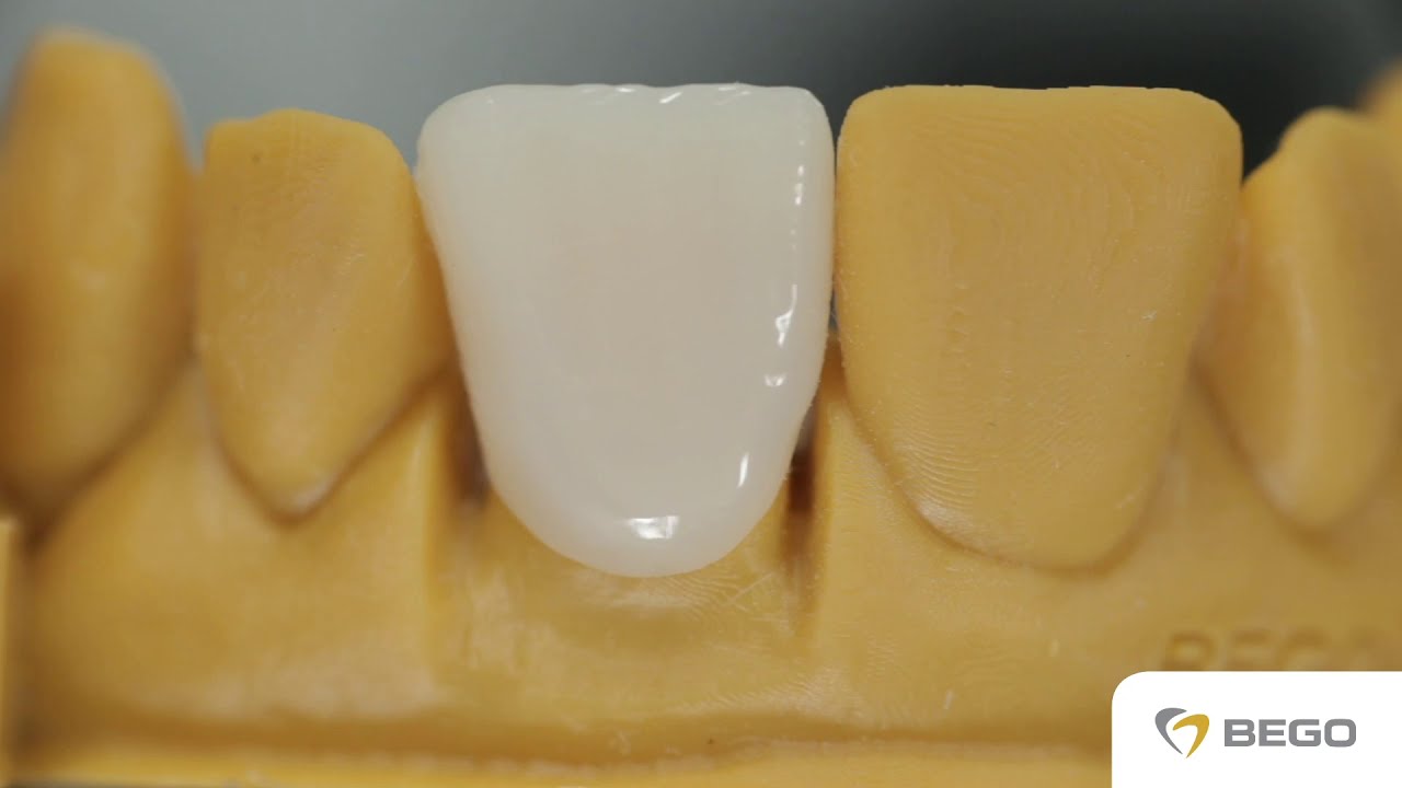 Post-processing of a 3D Printed Crown