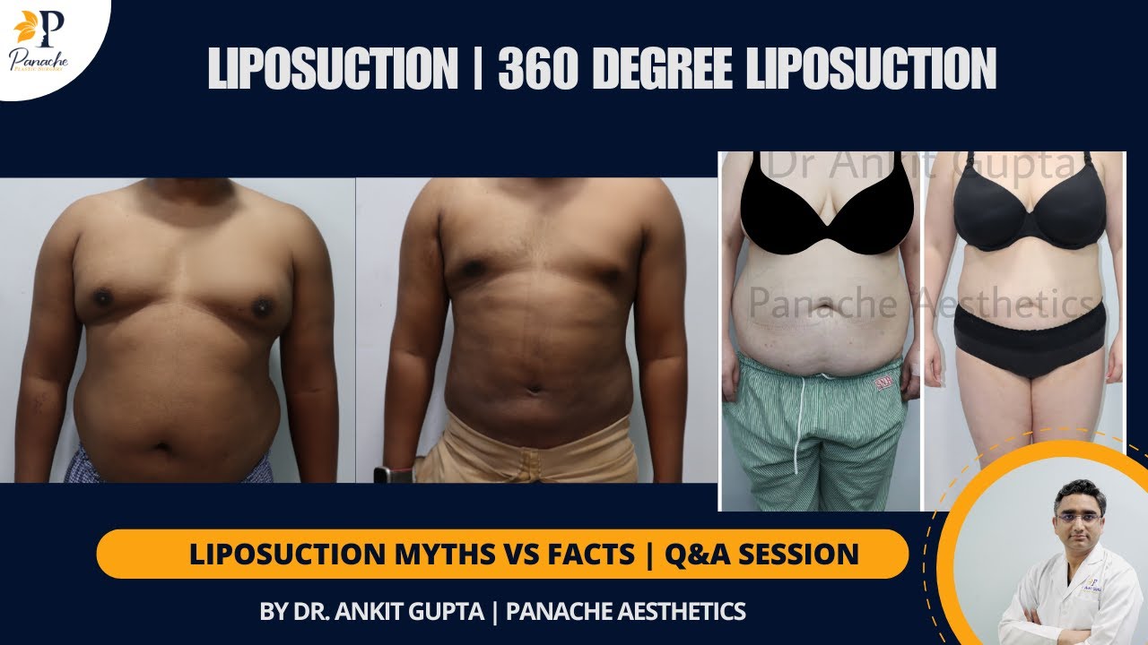Tummy Liposuction for Fat Removal | 360 Degree Liposuction Before & After | Fat Loss Surgery