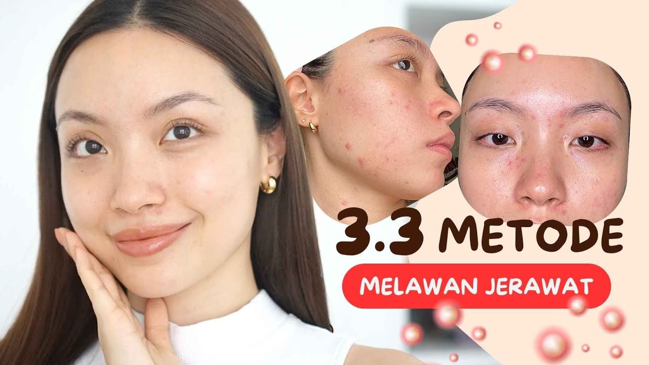 AKHIRNYA SEMBUH DARI JERAWAT | 3.3 METHOD How to fight ACNE