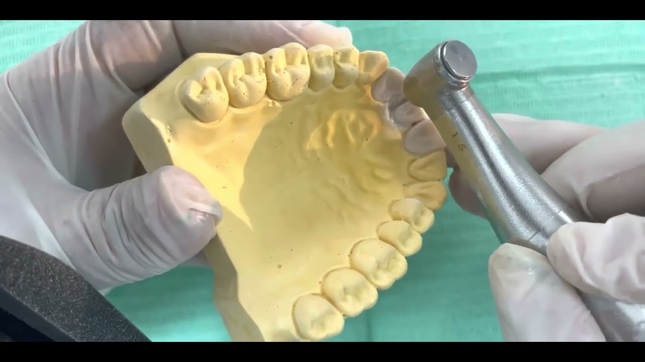 Préparation coronaire pour CCM sur dent antérieure - Metal Ceramic Crown preparation