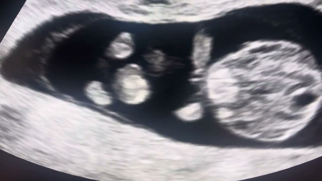 Fetal Midgut Rotation