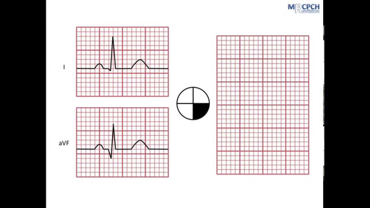 Working out the QRS axis on an ECG