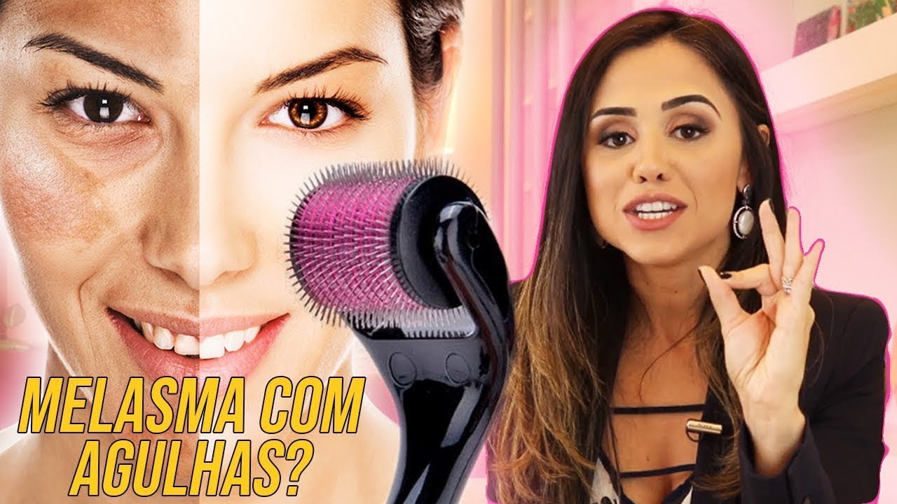 MICROAGULHAMENTO PARA MELASMA: PODE ISSO JOYCE? VEJA COMO FUNCIONA AGORA