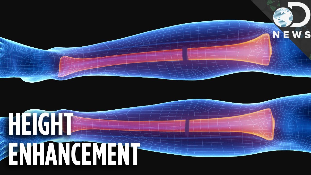 This Unorthodox Procedure Makes Short People A Foot Taller
