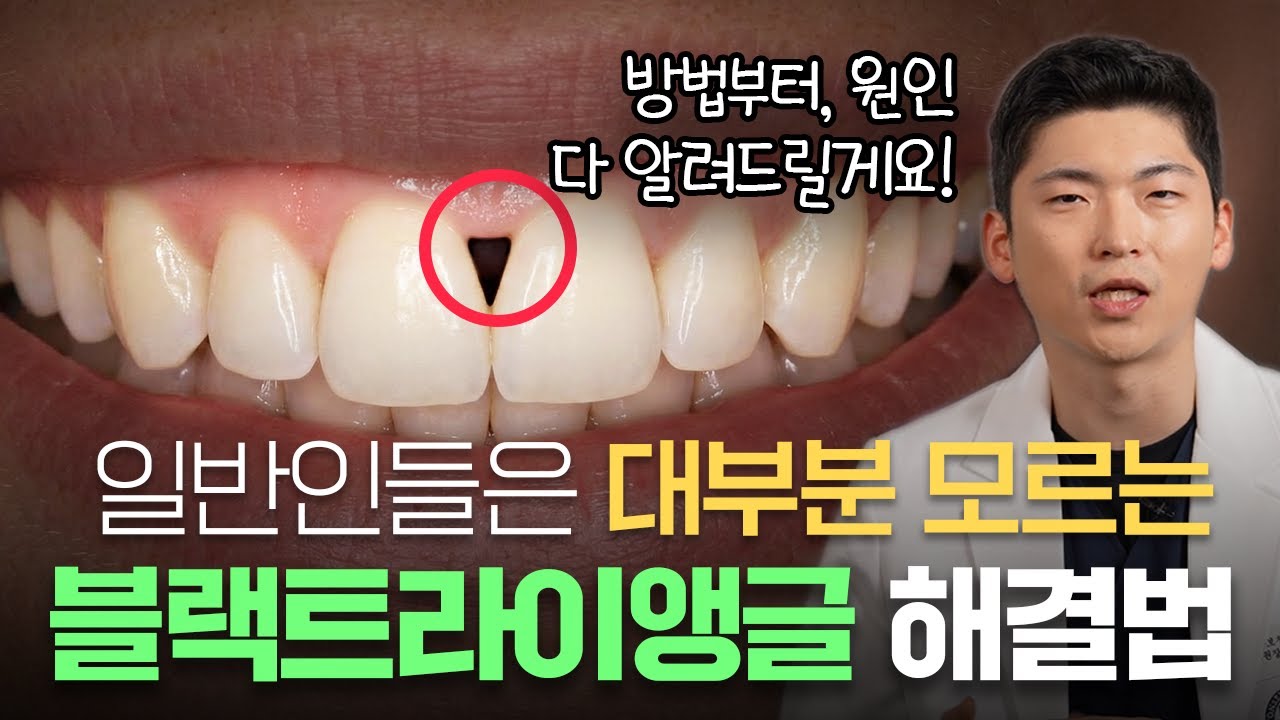 치아 사이 검은 삼각형, 왜 생길까? | 치과 전문의의 솔직한 설명