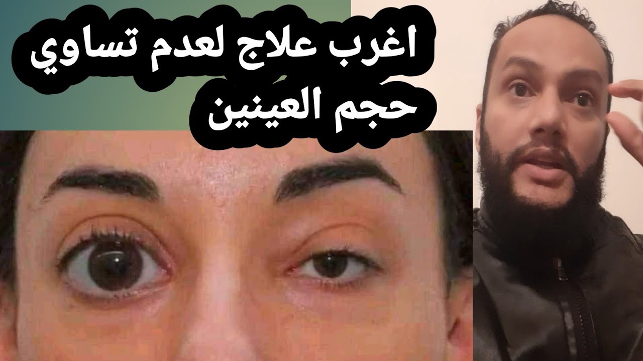علاج : عدم تساوي حجم العينين بحيت تصبح عين اكبر من عين ؟