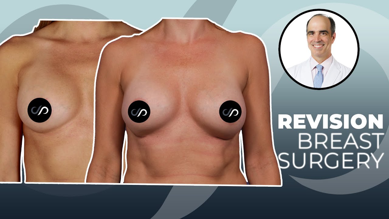 Best Results After Breast Revision Surgery - Dr. David Stoker