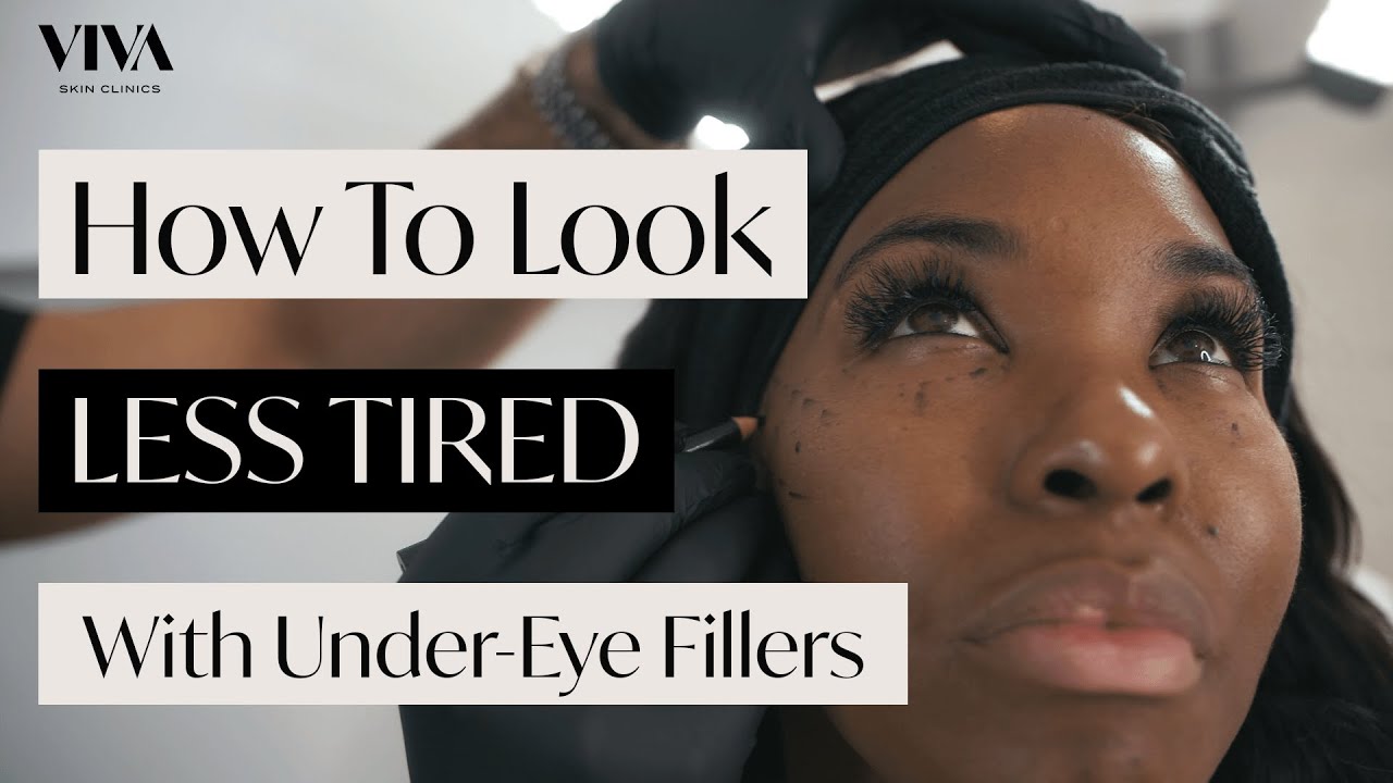 Under Eye Filler Injections for Dark Circles 👁 (Tear Trough Filler - Before and After!)