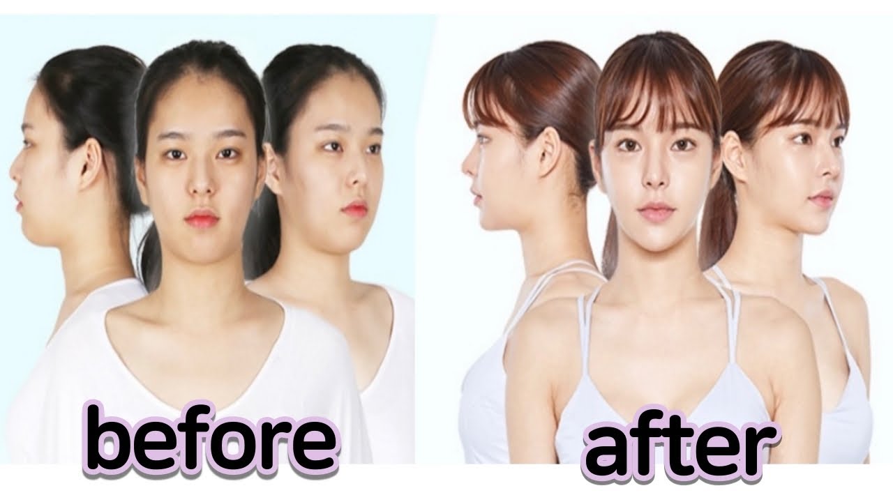 성형으로 인생이 변한 여자의 수술 시술 추천VS비추천
