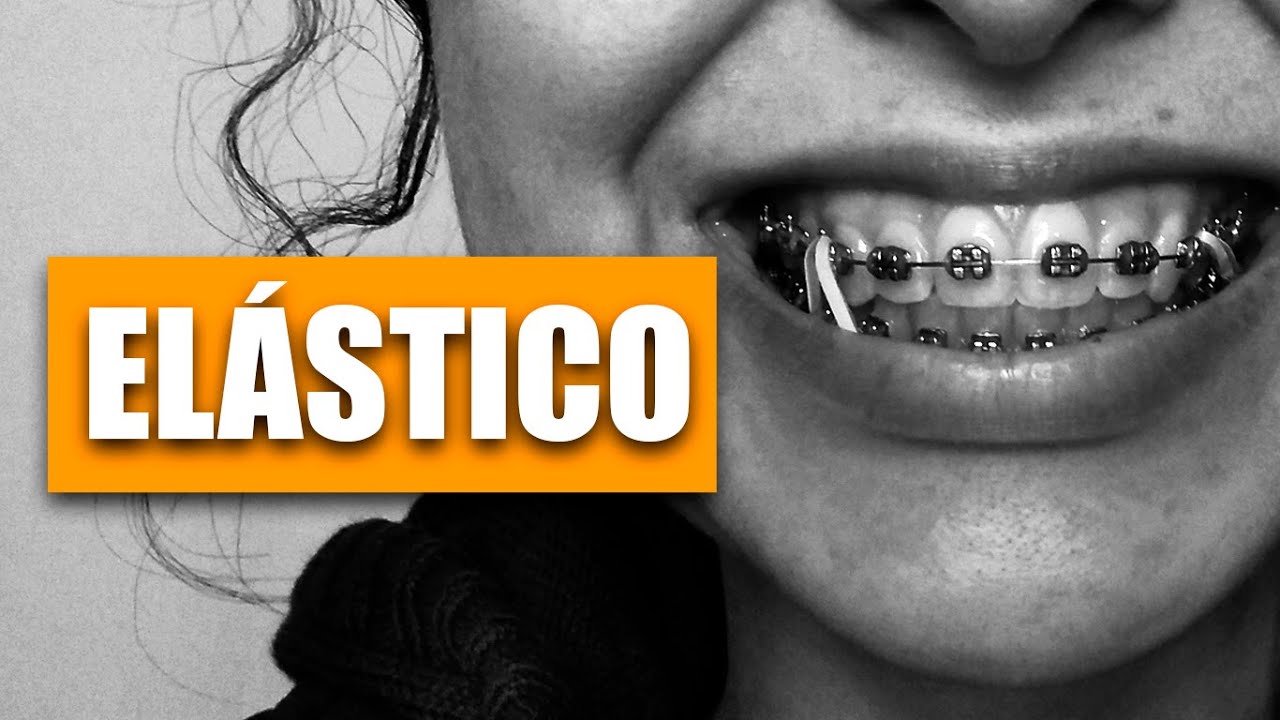 TIPOS DE ELÁSTICO - APARELHO ORTODÔNTICO | 