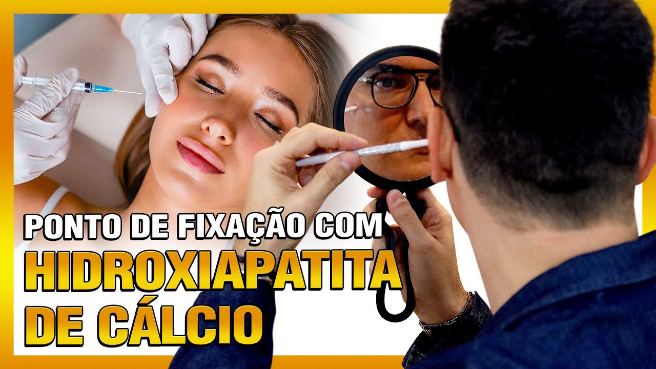 Ponto de fixação com HIDROXIAPATITA DE CÁLCIO