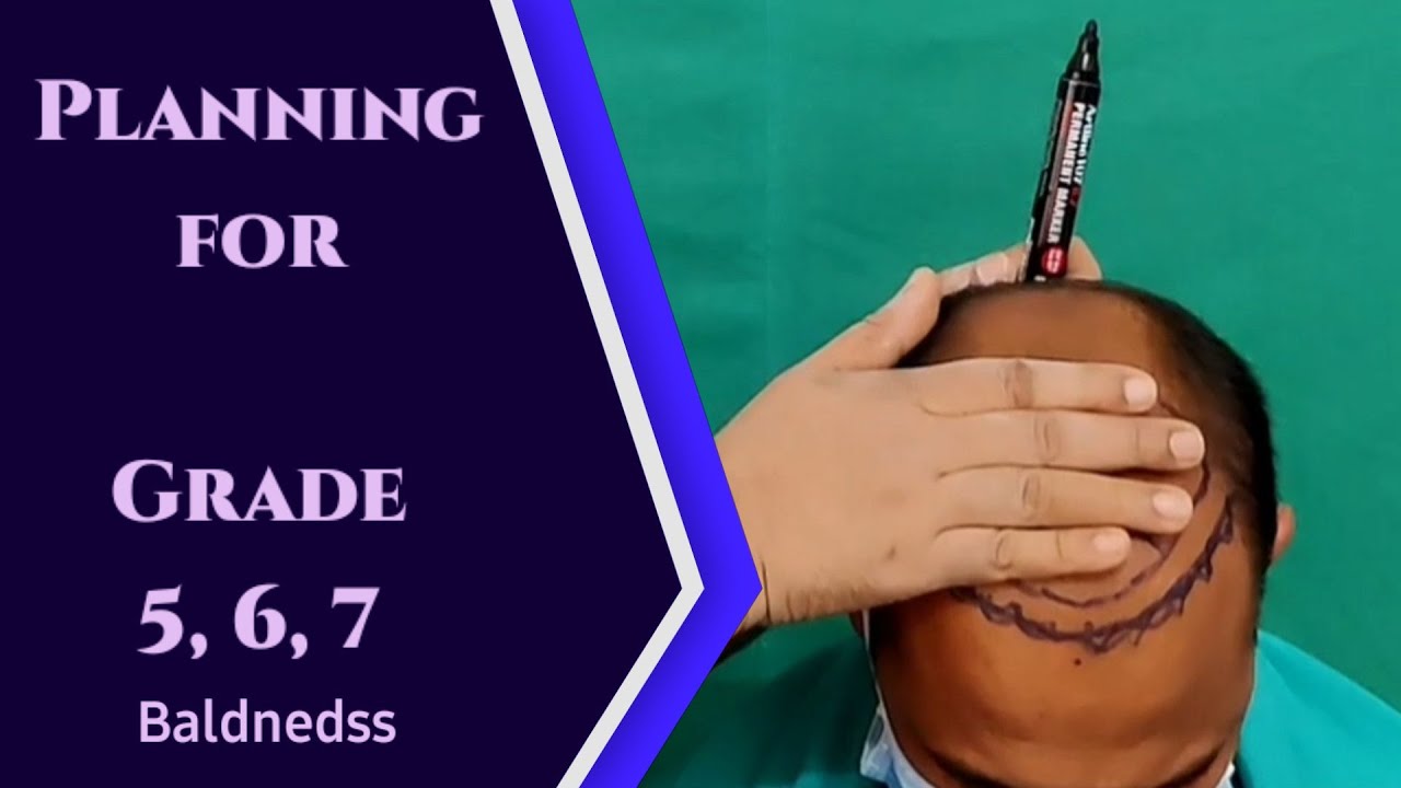 हेयर ट्रांसप्लांट ग्रेड 5, 6, 7 कैसे प्लानिंग करे || डा जयंत || प्लास्टिक एंड कॉस्मेटिक सर्जन