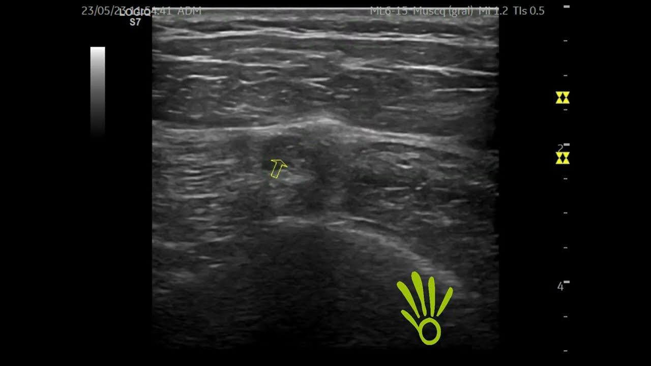 bursitis trocantérea