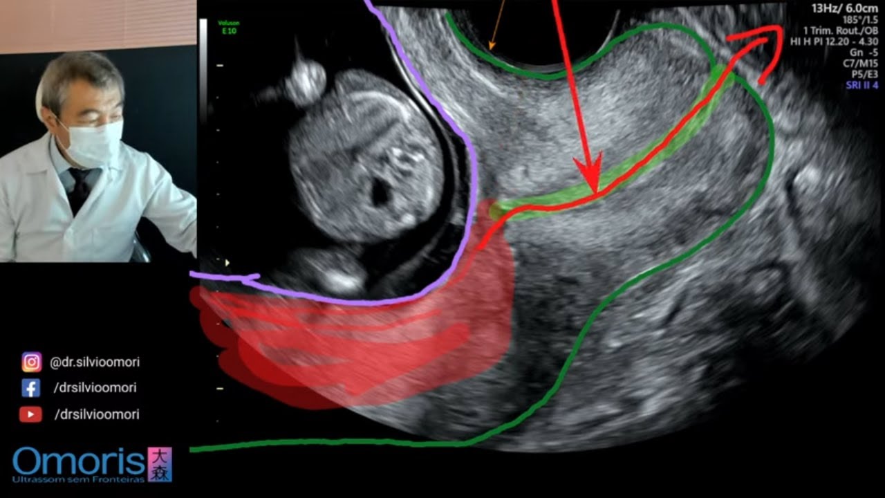 НИЗКАЯ ПЛАЦЕНТА! Разберитесь с одной из причин кровотечения при беременности.