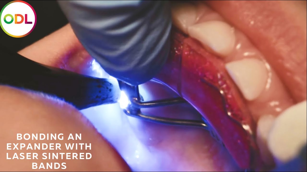 Delivering an expander with Laser Sintered Bands | ODL