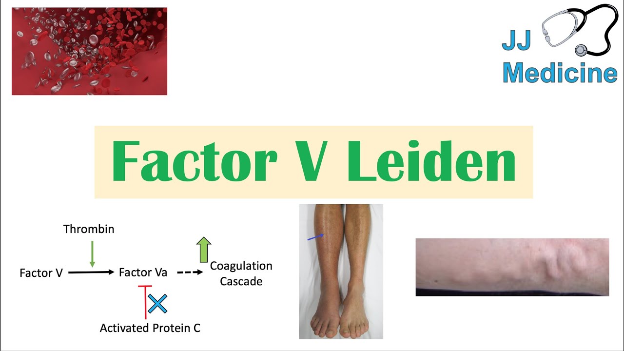 Factor V Leiden | Causes, Pathophysiology, Symptoms, Diagnosis, Treatment
