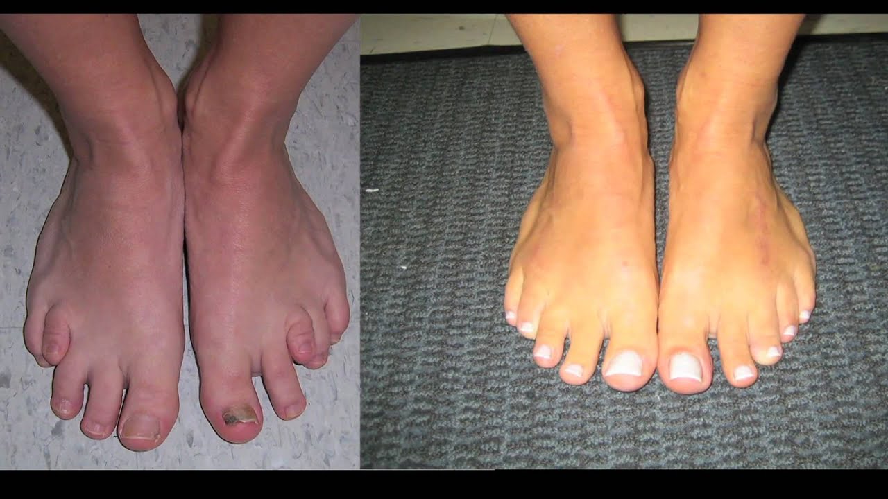 Limb Lengthening and Toe Lengthening with Dr. Rozbruch: Susan's Story