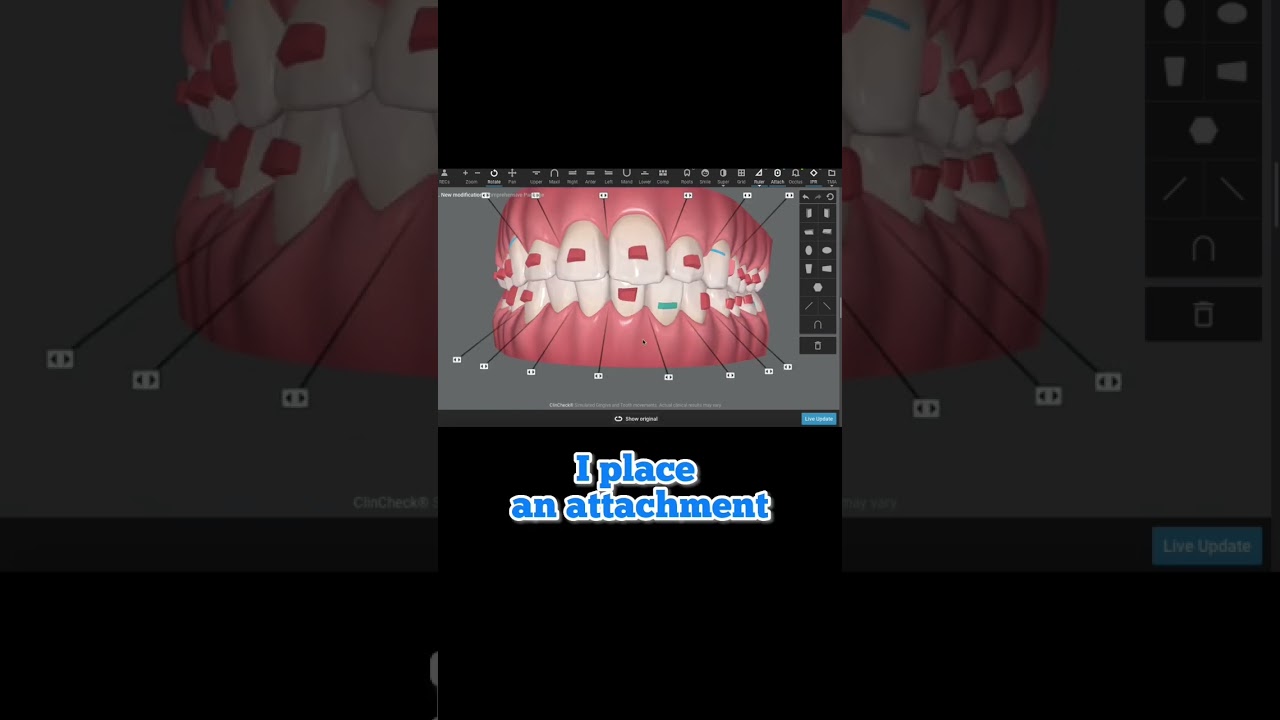 How Invisalign attachments work. An inside look at how we design smiles using Clincheck software.