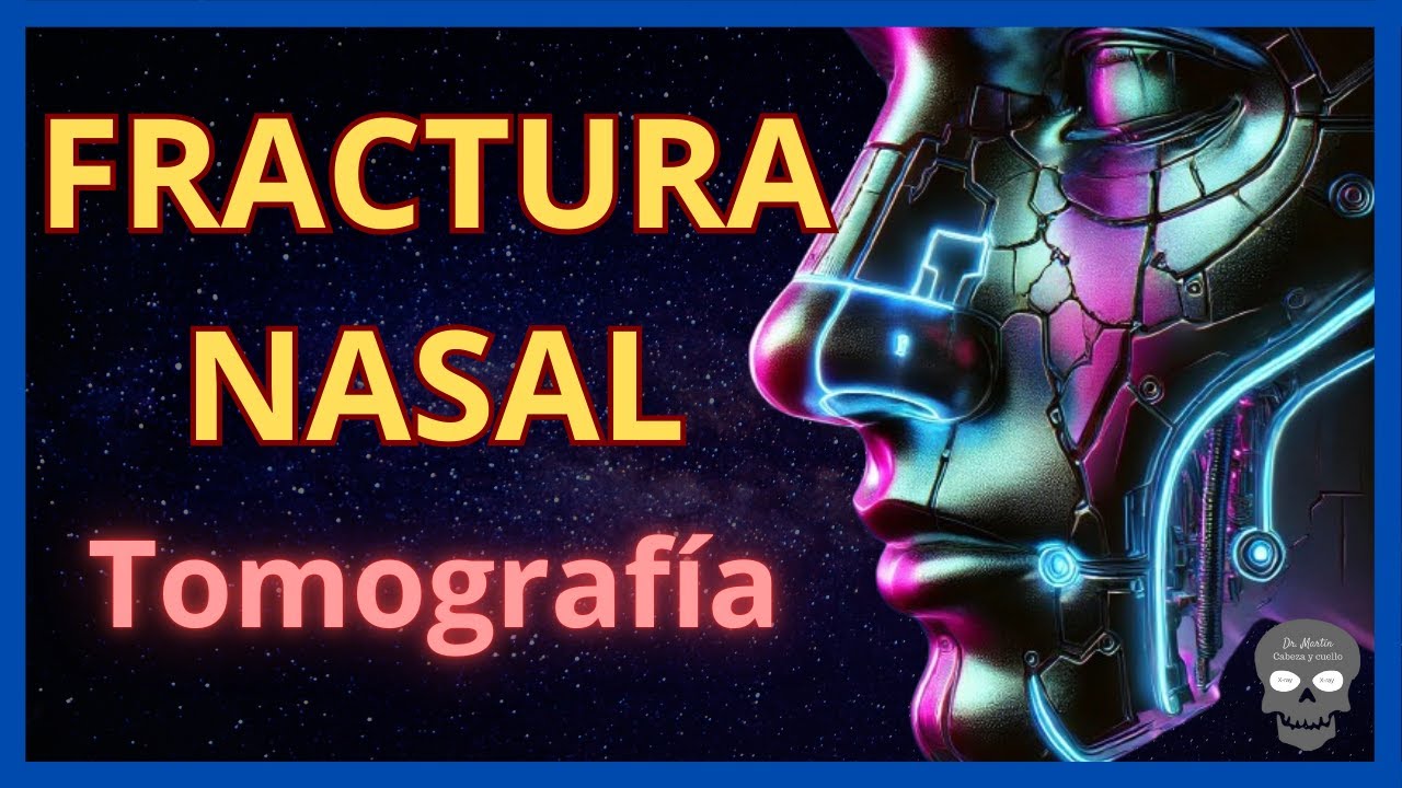 Fractura Nasal en Tomografía 🩻👃 Hallazgos Claves