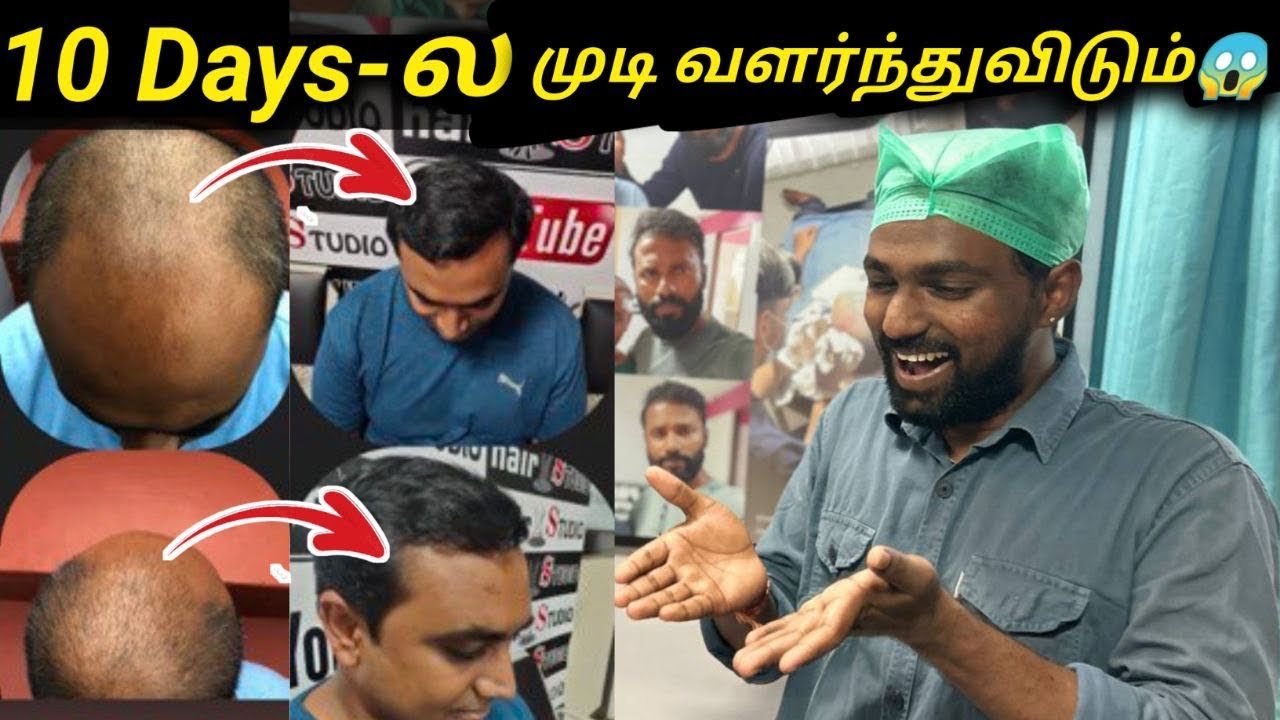 10 Days-ல முடி வளர்ந்துவிடும்😱 | Hair Loss Solution | PRP,GFC - treatment Tamil | vimals lifestyle