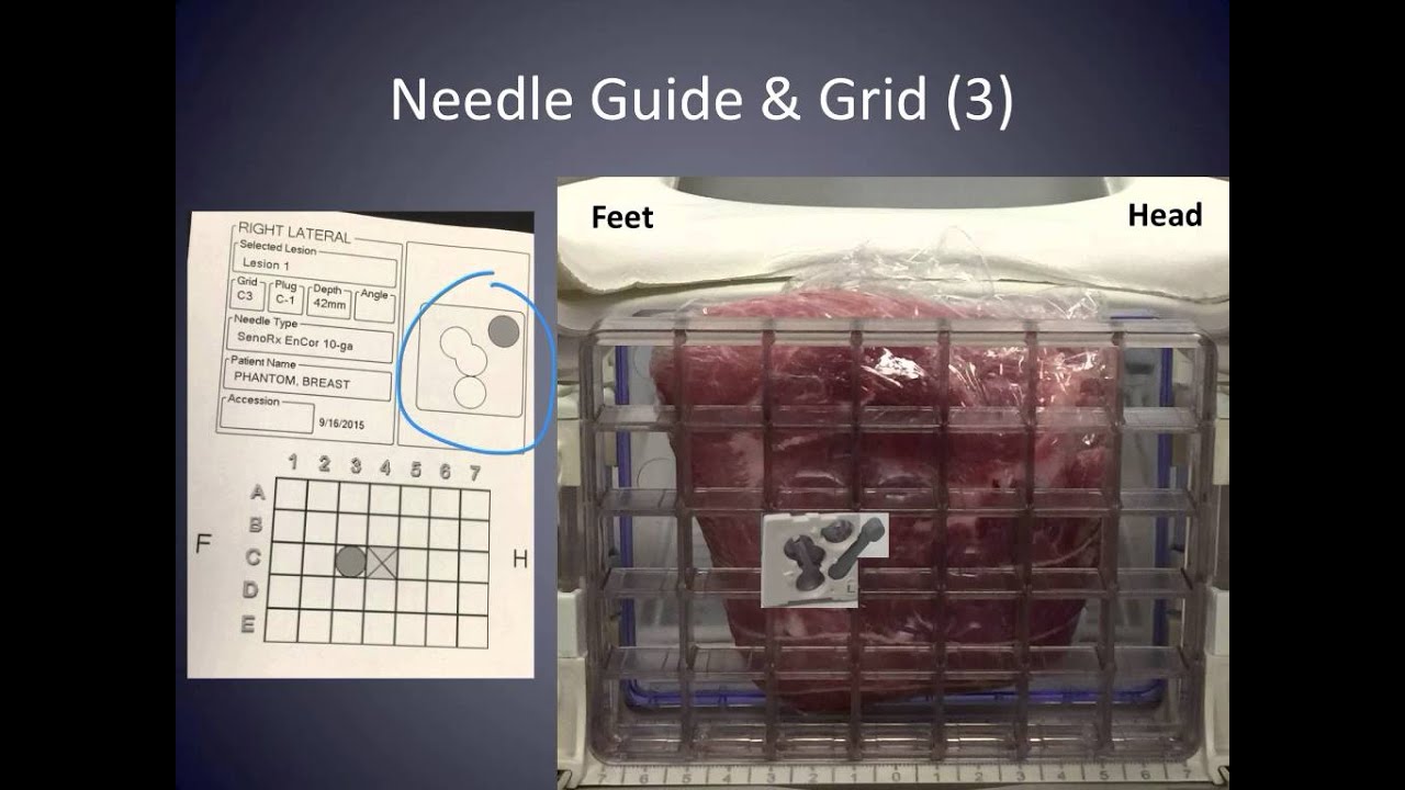MRI Breast Biopsy Section E - Tips and Tricks 3 on  Targeting for radiologists