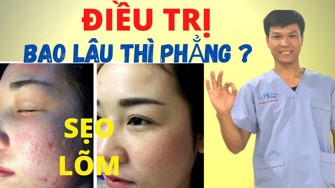 TRỊ SẸO RỖ [P2] - CÁCH NÀO CHỮA SẸO LÕM CHO BẠN -  ĐẦY SẸO sau 1 THÁNG, 3 THÁNG, 6 THÁNG | Dr Ninh