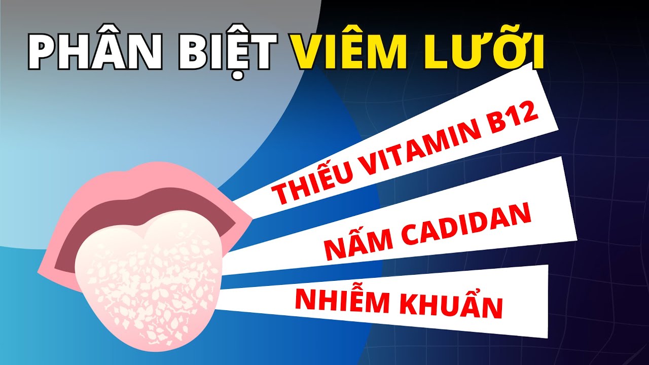 PHÂN BIỆT VIÊM LƯỠI do THIẾU VITAMIN B12, NẤM CANDIDA hay NHIỄM KHUẨN? | DS. Thu Hằng – Eduphar