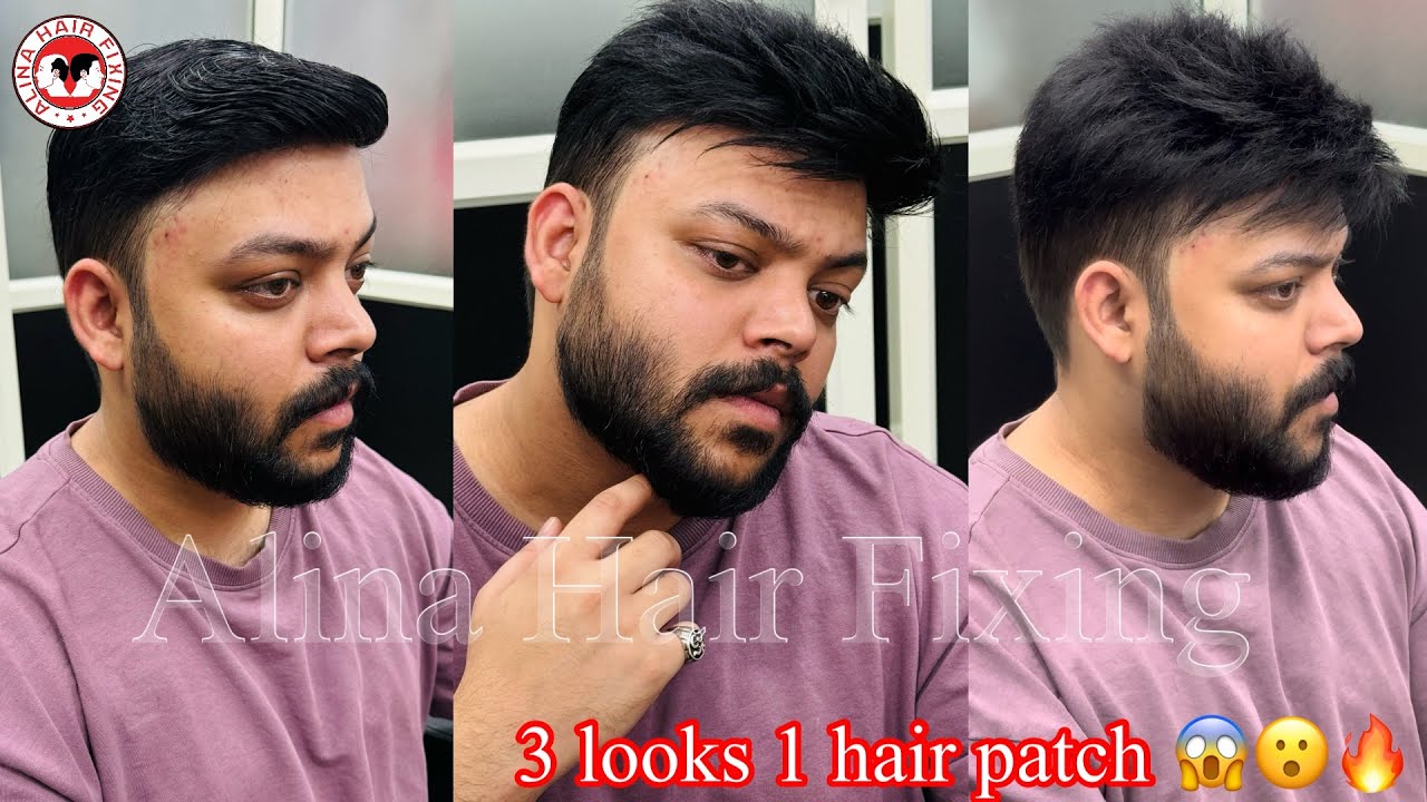 Hair Fixing Video 😱 Hair Patches for Men Hair Fixing in Bangalore Call - 9731827386