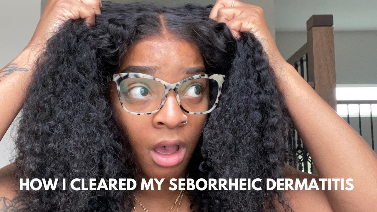 I Cured My Seborrheic Dermatitis (And You Can Too!)