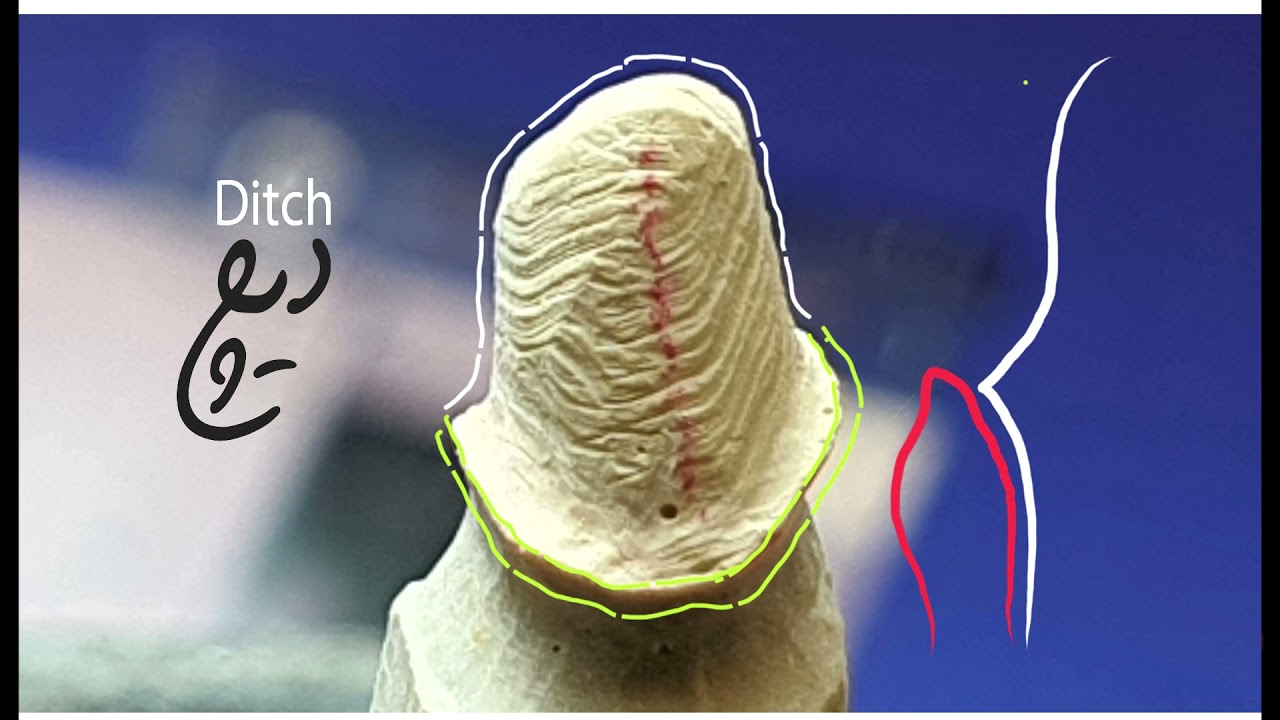 dental trimming(دیچ کردن دای)