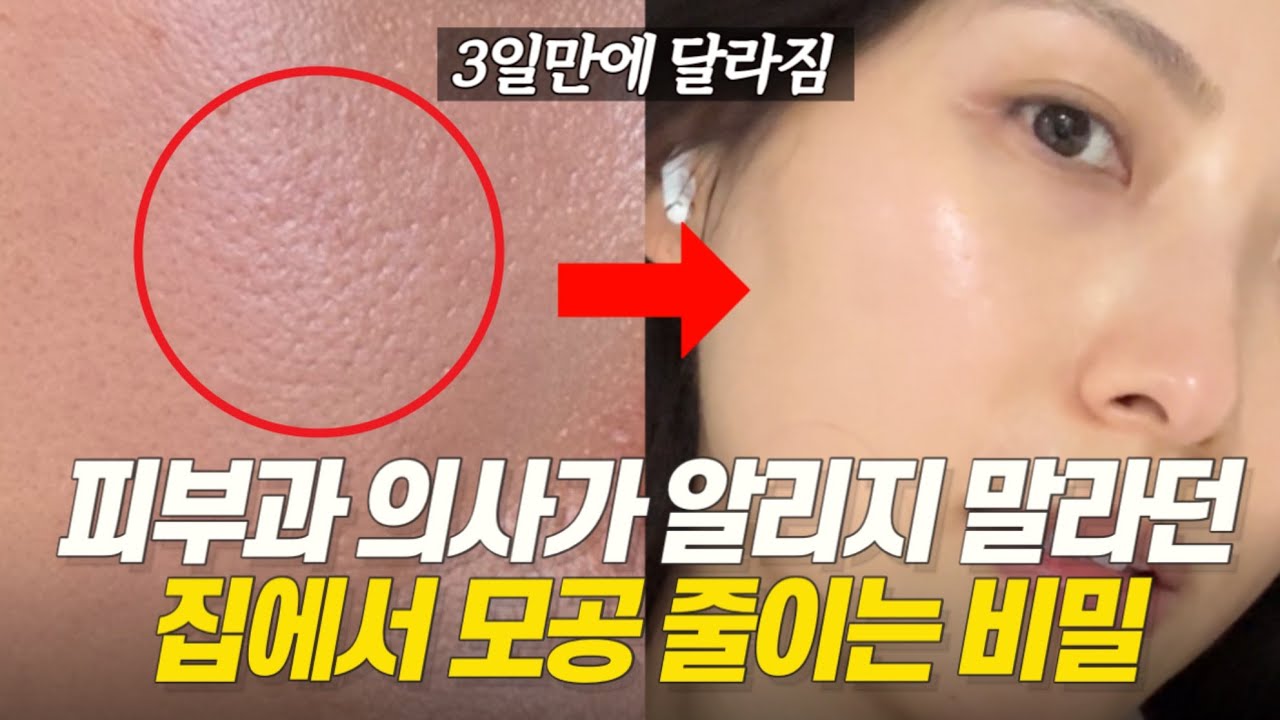 이제 피부과 안가도 됩니다! 집에서 모공, 여드름 흉터 없애는 MTS 홈케어 루틴