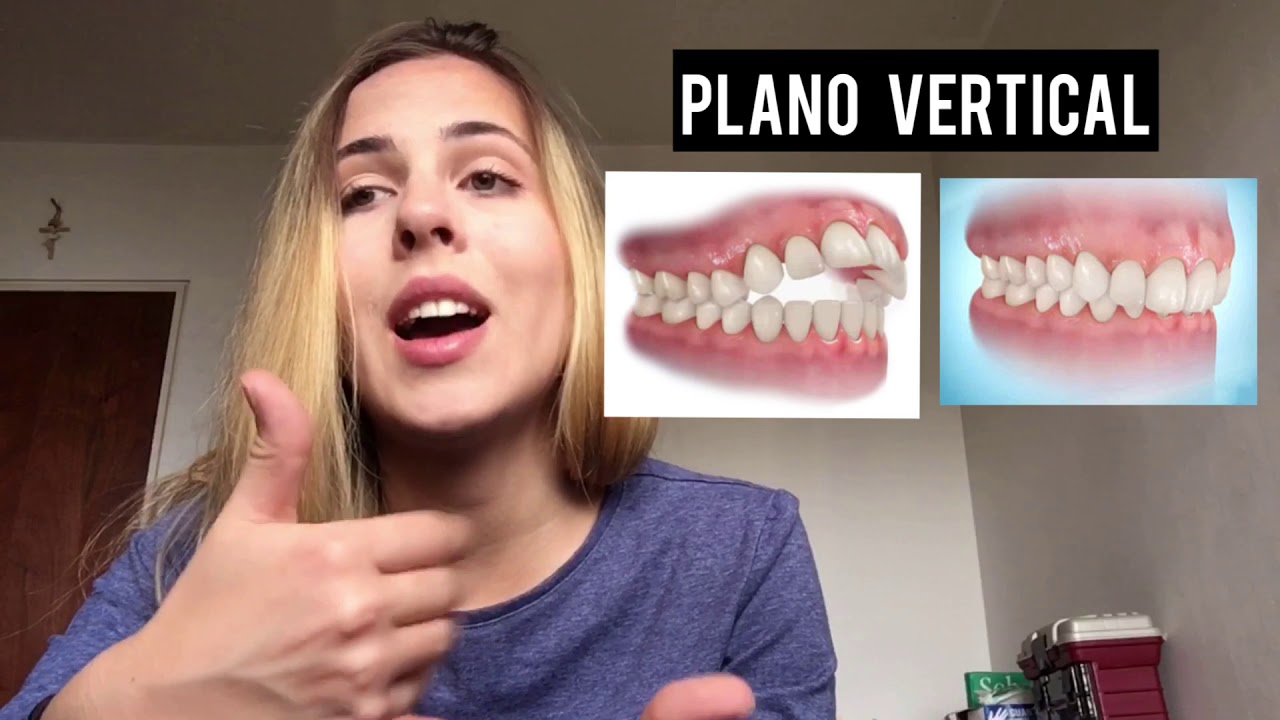 Maloclusiones en los 3 planos