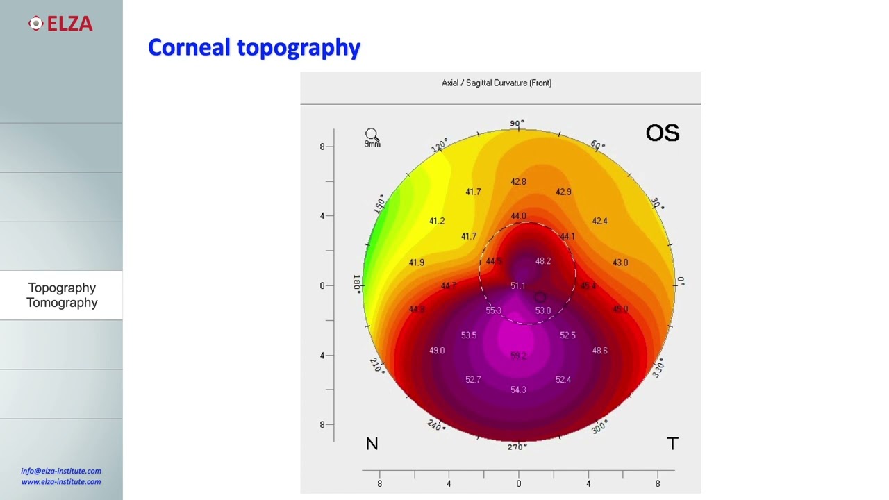 Screening and Diagnosing Keratoconus | L. Kollros