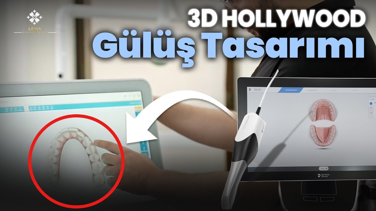 🤍 Что такое 3D-дизайн голливудской улыбки? — Стоматологическая клиника Lema