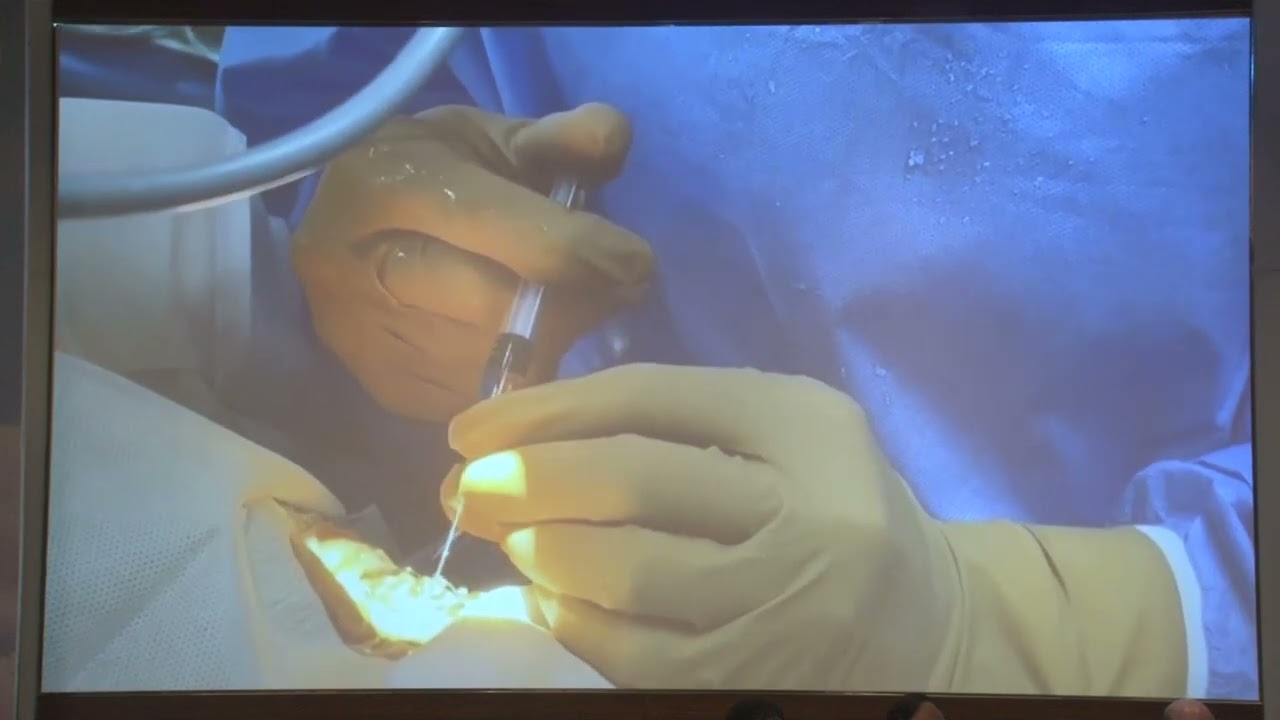 AIOC2022 GP167 topic Dr Nitin Deshpand iStent inject  Glaukos  Next Generation MIGS Solution for Gla