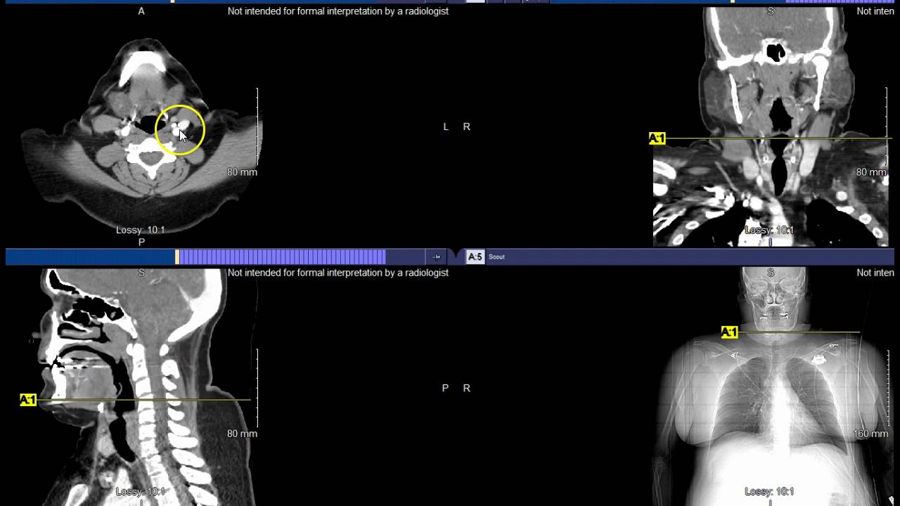 PACS - CT Neck