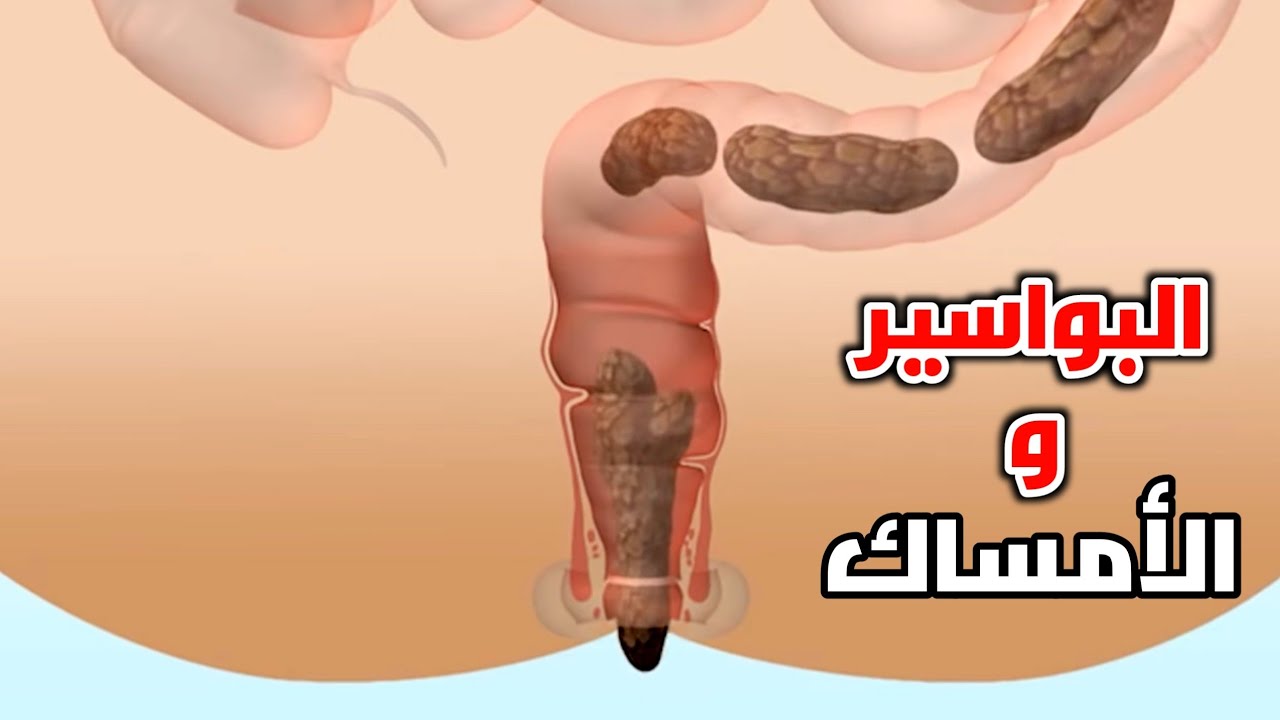شاهد كيف تحدث البواسير _ How do hemorrhoids occur?