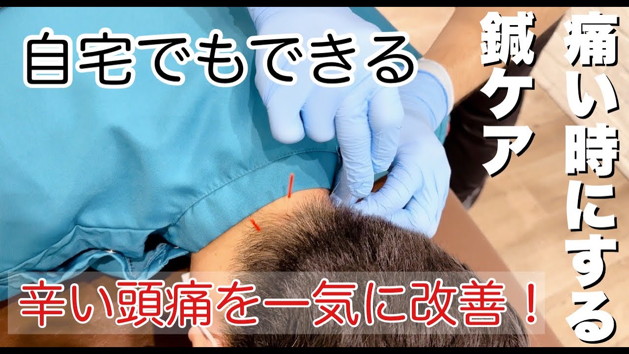 頭痛　鍼】『辛い頭痛を一気に改善！　痛い時の鍼ケア』【接骨　鍼灸　船堀】