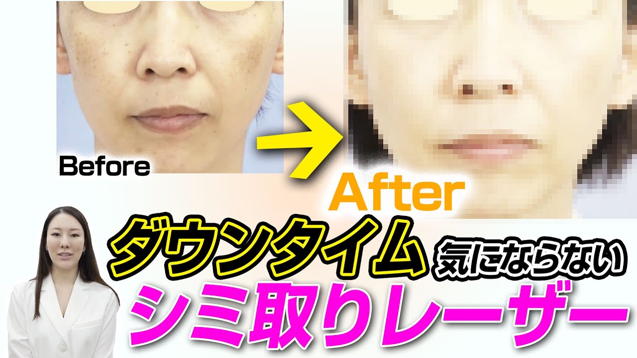 ダウンタイム気にならないシミ取りレーザーについて解説します。