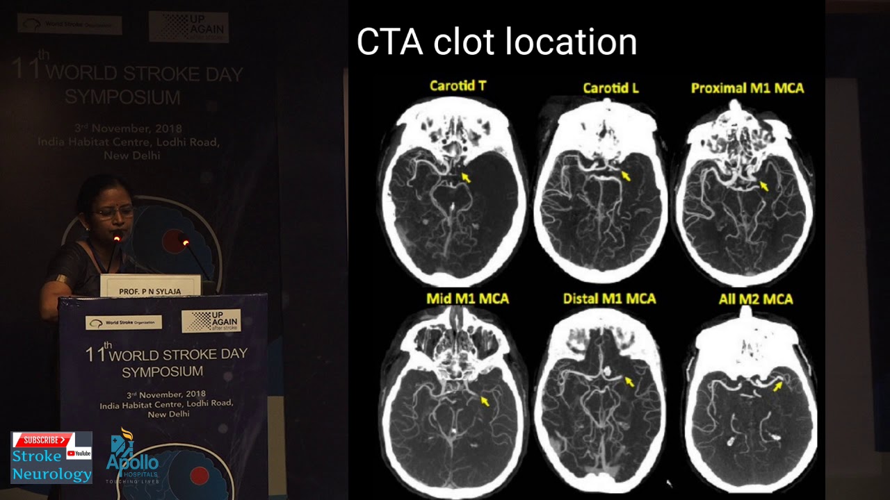 DEFUSE 3 and Recent Stroke Trials - Prof P N Sylaja