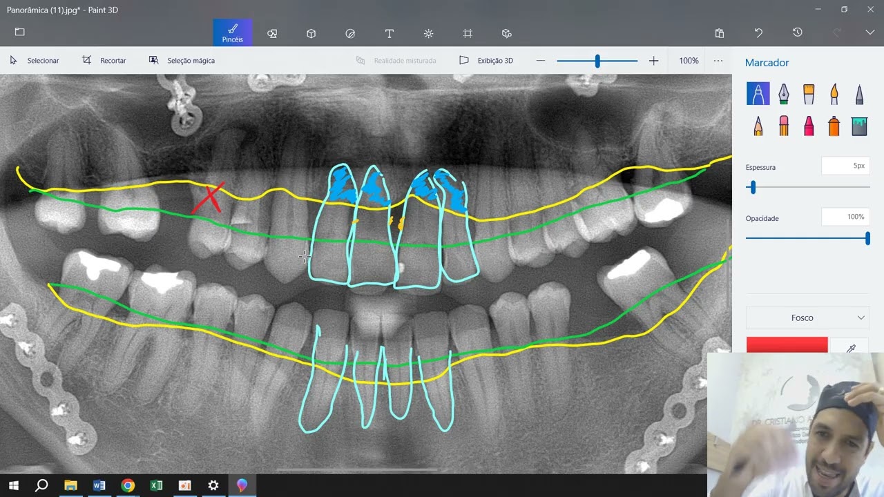 Fra_Pau_Sed_Jun - Exodontia + Tratamento Periodontal Complexo