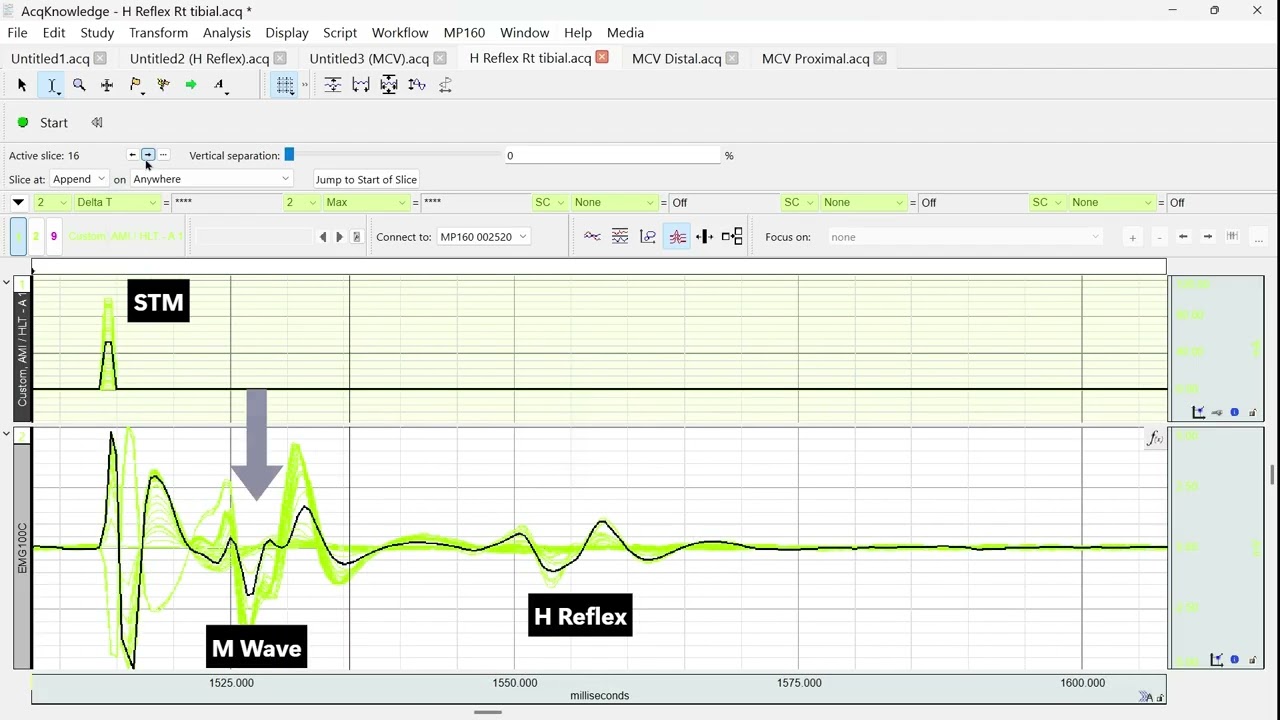 H-reflex with M wave and F wave