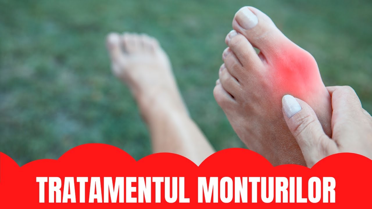 TRATAMENTUL MONTURILOR