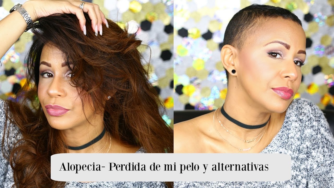 Alopecia - Perdida de pelo y alternativas