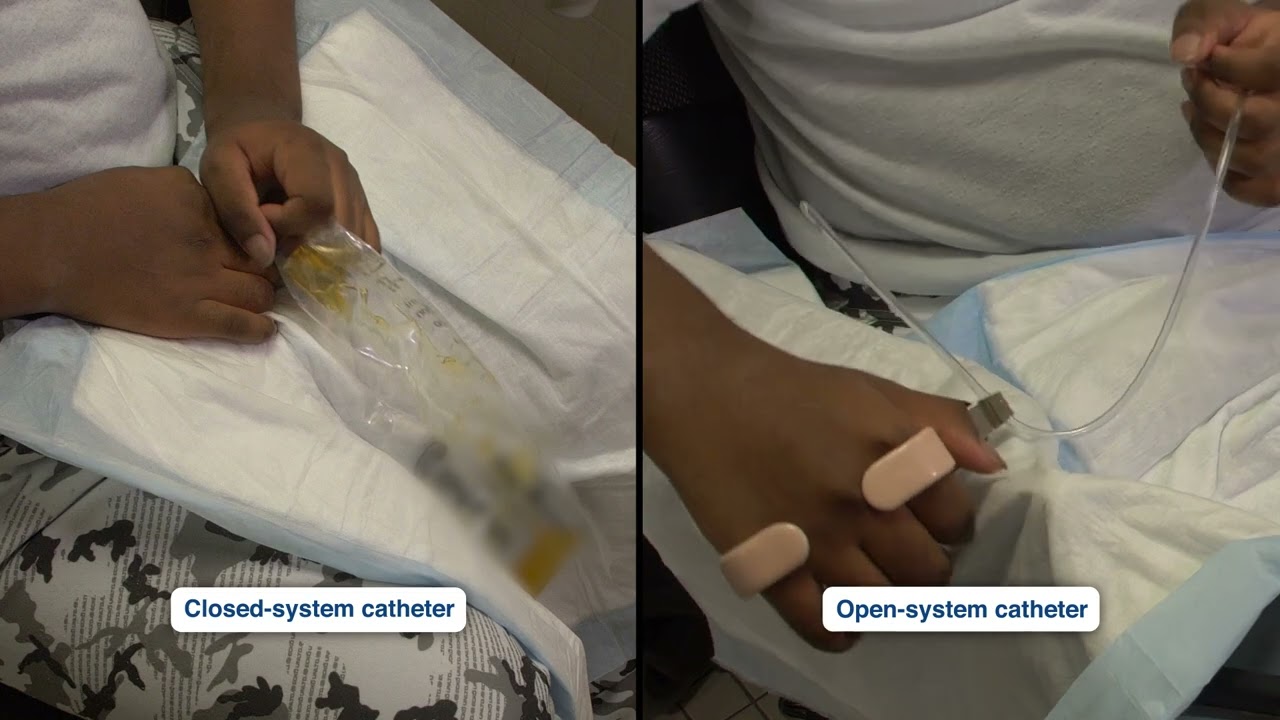 SCI Video: Bladder Self-Catheterization by a Male with Limited Hand Function