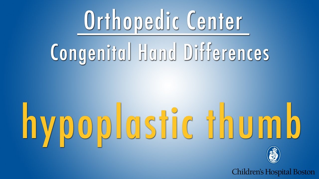 hypoplastic thumb - congenital hand differences - Boston Children's Hospital
