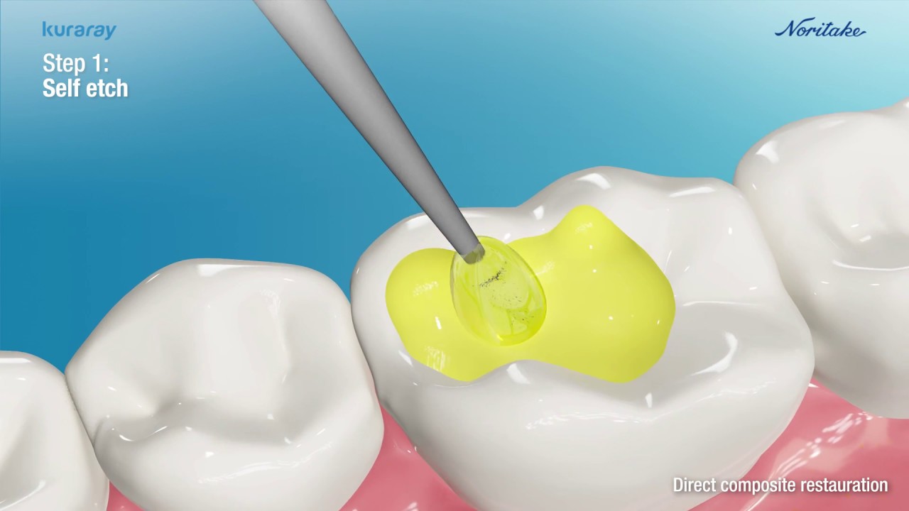 CLEARFIL Universal Bond Quick Commercial English