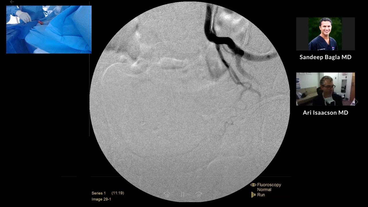 TruSelect&trade; Microcatheter Live Case Recording