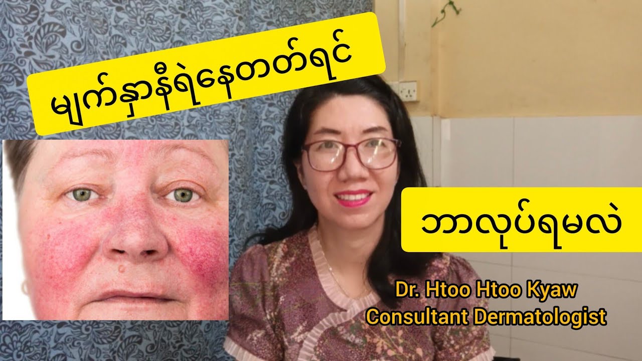 Flashing or red face? ဘာကြောင့်ပဲမျက်နှာရဲပါ စေ သက်သာစေဖို့အတွက်ပါ။